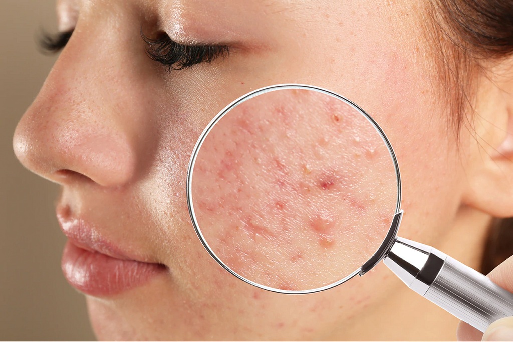 Makeup and Skincare Steps to Get Rid of Acne